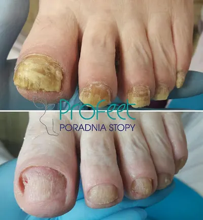 ProFeet Poradnia Stopy - PODOLOGIA OPOLE - Gabinet Podologiczny PODOLOG - mgr Klaudia Kainka